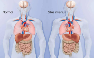 Situs İnversus Nedir