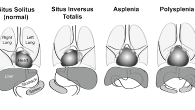 Situs İnversus Nedir